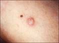 Carcinoma Escamoso | Patologias Dermatologicas